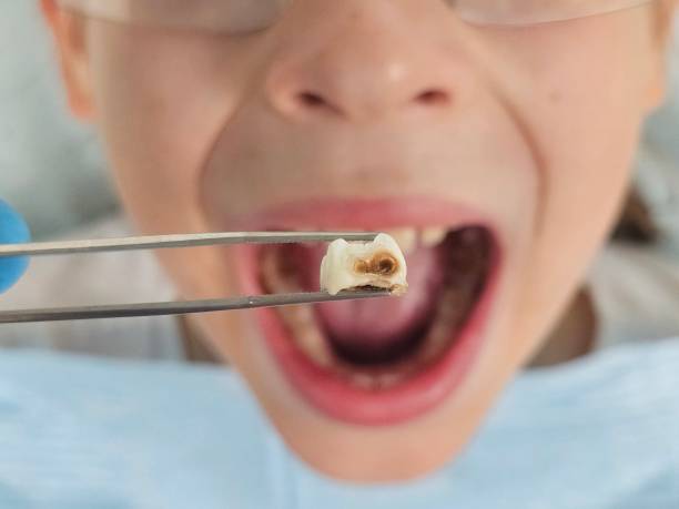 Best Emergency Care for Gum Disease in Kathleen, FL