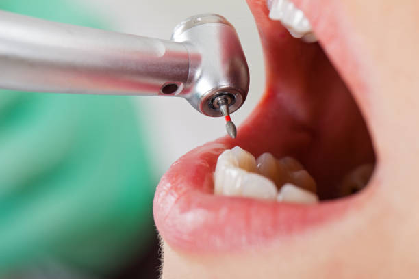 Best Lost Filling or Crown Replacement in Kathleen, FL
